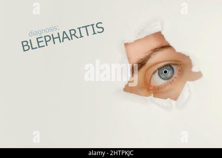 Blepharitis disease poster with blue eye on right. Studio grey background Stock Photo
