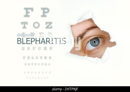 Blepharitis disease poster with eye test and blue eye on right. Isolated on white Stock Photo