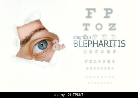 Blepharitis disease poster with eye test and blue eye on left. Isolated on white Stock Photo