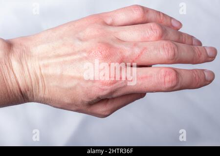 Strange scratches keep appearing on my palm? What are they? | Mumsnet