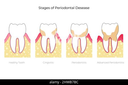 Stages of periodontal disease, illustration Stock Photo