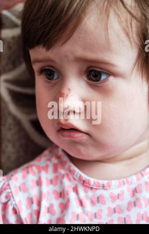 Portrait of a sad little girl with a scratched nose, close-up, selective focus. Child safety concept, injuries from falling down. Stock Photo
