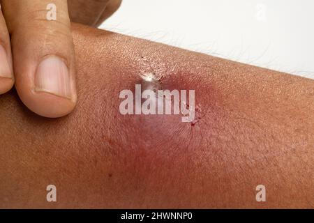 The patient had an abscess on his arm that was scratched by a cat. Stock Photo