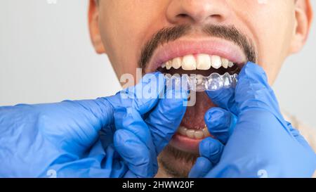 Man's smile with dental braces on teeth Stock Photo - Alamy