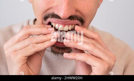 Caucasian young man adjusting and placing an invisible silicone aligner for dental correction. Male hand holding the plastic braces dentistry retainer Stock Photo