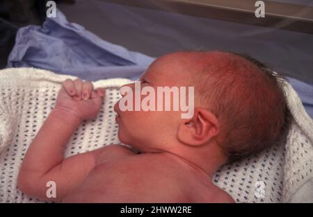 newborn baby with elongated skull following long and difficult labour Stock Photo