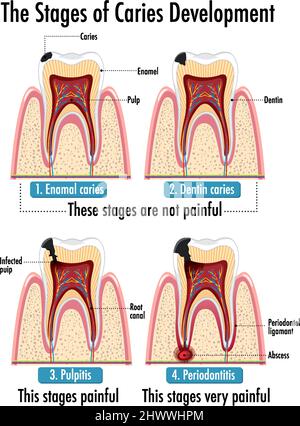 Infographic of human in the stages of caries development illustration ...