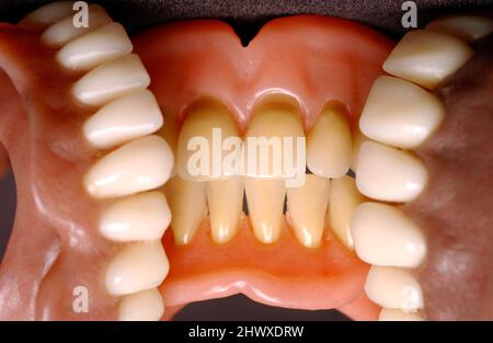 Close up of a two sets of dentures. Dentures or false teeth are made from an acrylic base on which acrylic or ceramic teeth are mounted. Dentures are Stock Photo