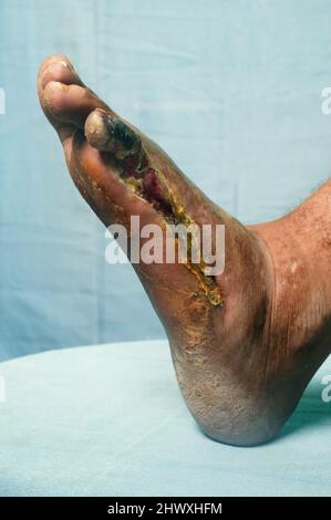 Close up of a left foot with Buerger's disease - inflammation of the blood vessels of the extremties, producing clotting within them. Accordingly, the Stock Photo