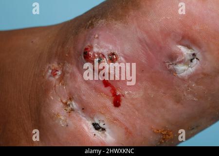 Close up of the foot of a mycetoma sufferer.  Mycetoma is an uncommon disease found in the tropics. It is a chronic, localised infection of the skin a Stock Photo