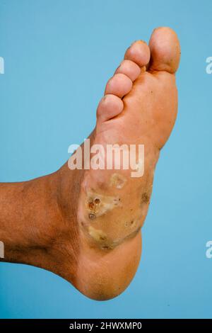 Close up of the foot of a mycetoma sufferer.  Mycetoma is an uncommon disease found in the tropics. It is a chronic, localised infection of the skin a Stock Photo