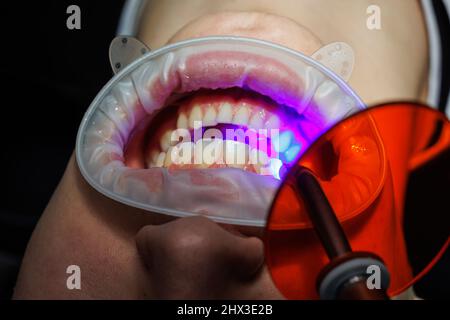 Patient with open mouth lying in the dentist's chair while the dentist holds a dental instrument. Dental treatment in a modern dental clinic. selectiv Stock Photo