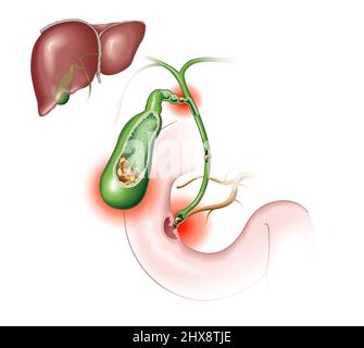 Gallstone disease. gallstones blocking bile duct and pancreatic duct ...