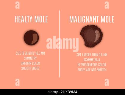 Comparison between healty mole and dangerous mole. Risk of skin cancer. Illustration Stock Photo