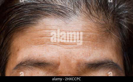 Skin creases or wrinkles at oily forehead of Southeast Asian, Myanmar or Burmese elder woman. Symptom of aging. Stock Photo