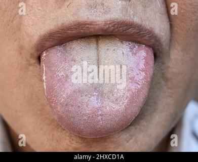 Fissured tongue of Southeast Asian elder man. It is marked by a deep, prominent groove in the middle. Stock Photo