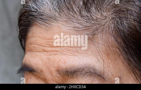 Skin creases or wrinkles at oily forehead of Southeast Asian, Myanmar or Burmese elder woman. Symptom of aging. Stock Photo