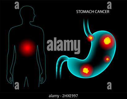 Stomach cancer, illustration Stock Photo