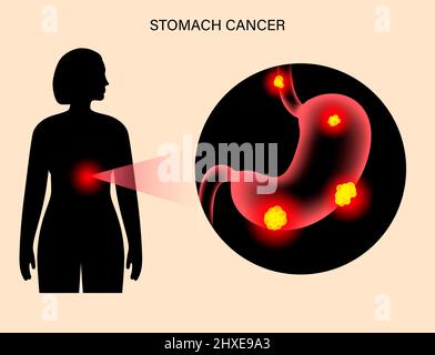 Stomach cancer, illustration Stock Photo