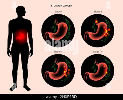 Stomach cancer, illustration Stock Photo