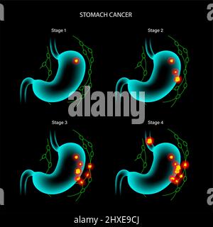 Stomach cancer, illustration Stock Photo