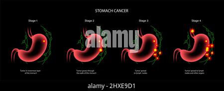 Stomach cancer, illustration Stock Photo