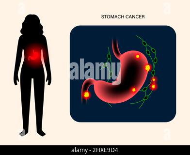 Stomach cancer, illustration Stock Photo