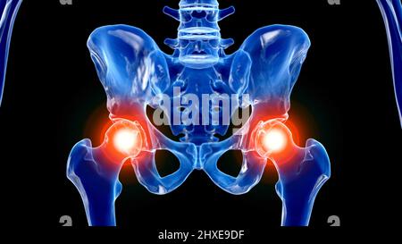 Painful hip joint, illustration Stock Photo