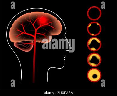 Ischaemic Stroke, Illustration Stock Photo - Alamy