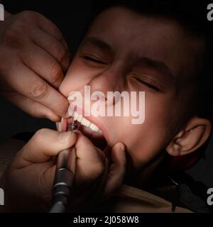 Drilling a diseased tooth with caries with a drill in dentistry during ...