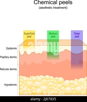 Acne treatment. Cross section of the human skin with Inflamed pimple ...