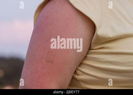 irritated sunburn on womans arm in summer with freckles Stock Photo
