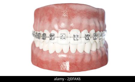 Dental braces, illustration Stock Photo