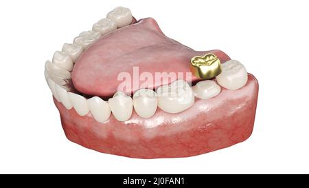 Dental crown, illustration Stock Photo