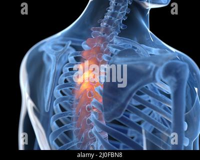 Painful thoracic spine, illustration Stock Photo
