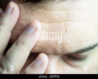 A close-up photo of man pressing his fingers to his forehead, wrinkling his forehead and closing his eyes, showing a headache Stock Photo