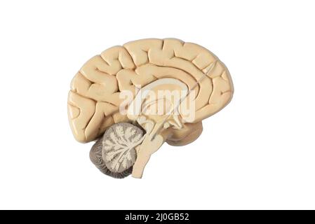 Deep brain stimulation at subthalamic nucleus for the treatment of parkinson's disease. Lead on brain model isolated on white background. Stock Photo