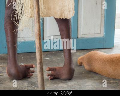 A person with leg deformities due to polio or other diseases in the middle of the Indonesian jungle Bird's Head Peninsula, West Papua, Indonesia, Asia Stock Photo