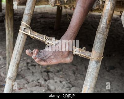 A person with leg deformities due to polio or other diseases in the middle of the Indonesian jungle Bird's Head Peninsula, West Papua, Indonesia, Asia Stock Photo