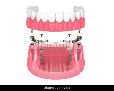 Bar retained removable overdenture installation supported by implants over white backgroud Stock Photo