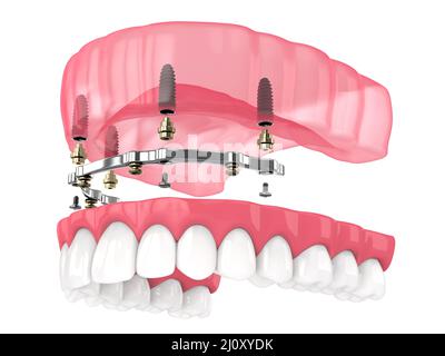 Bar retained removable overdenture installation supported by implants over white backgroud Stock Photo