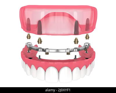 Bar retained removable overdenture installation supported by implants over white backgroud Stock Photo