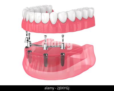 Removable overdenture installation on bar clip attachment, supported by implants over white background Stock Photo