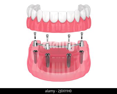 Removable overdenture installation on bar clip attachment, supported by implants over white background Stock Photo