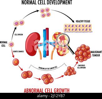 Diagram showing normal cell and cancer cell illustration Stock Vector ...