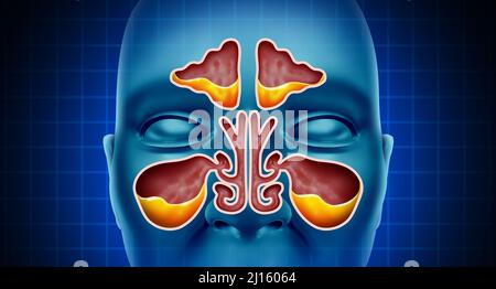 Sinus Infection and Sinusitis illness as a nasal cavity blockage disease with a congested nose full of mucus or pus. Stock Photo