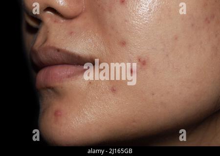 Acne, red spots and scars on face of Asian young woman. Stock Photo