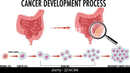 Diagram showing cancer development process illustration Stock Vector