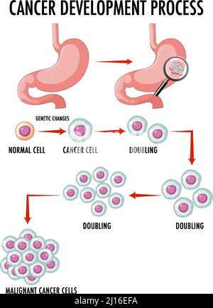 Diagram showing cancer development process illustration Stock Vector