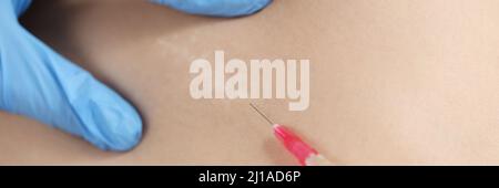 Doctor injecting medication in area of postoperative scar on skin closeup Stock Photo